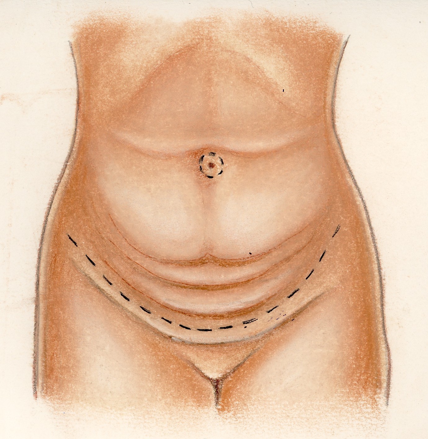 Plastie abdominale - Tarif et infos Abdominoplastie à Paris