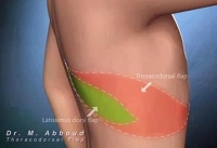 Deepithelialized thoracodorsal flap