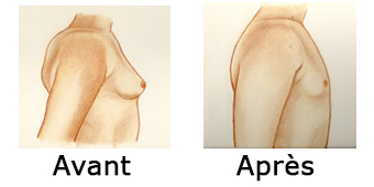 gynecomastie comparaison