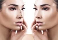 Rhinoplasty in Belgium : when is this Reconstructive procedure indicated ?