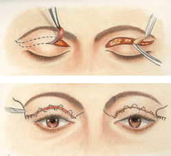 Blépharoplastie des paupières supérieures