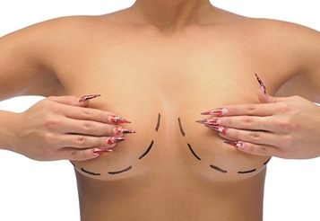 Breast surgery