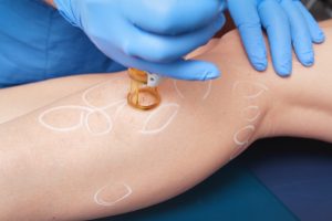 Couperose, angiome etc., les pathologies vasculaires sont nombreuses à pouvoir être soignées par laser. Plus d’infos sur ce traitement.