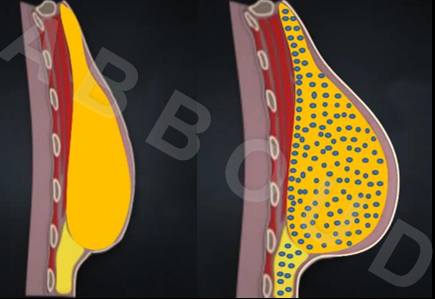 augmentation mammaire par lipofilling à Bruxelles - Ma Clinic